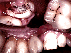 Rotting Teeth